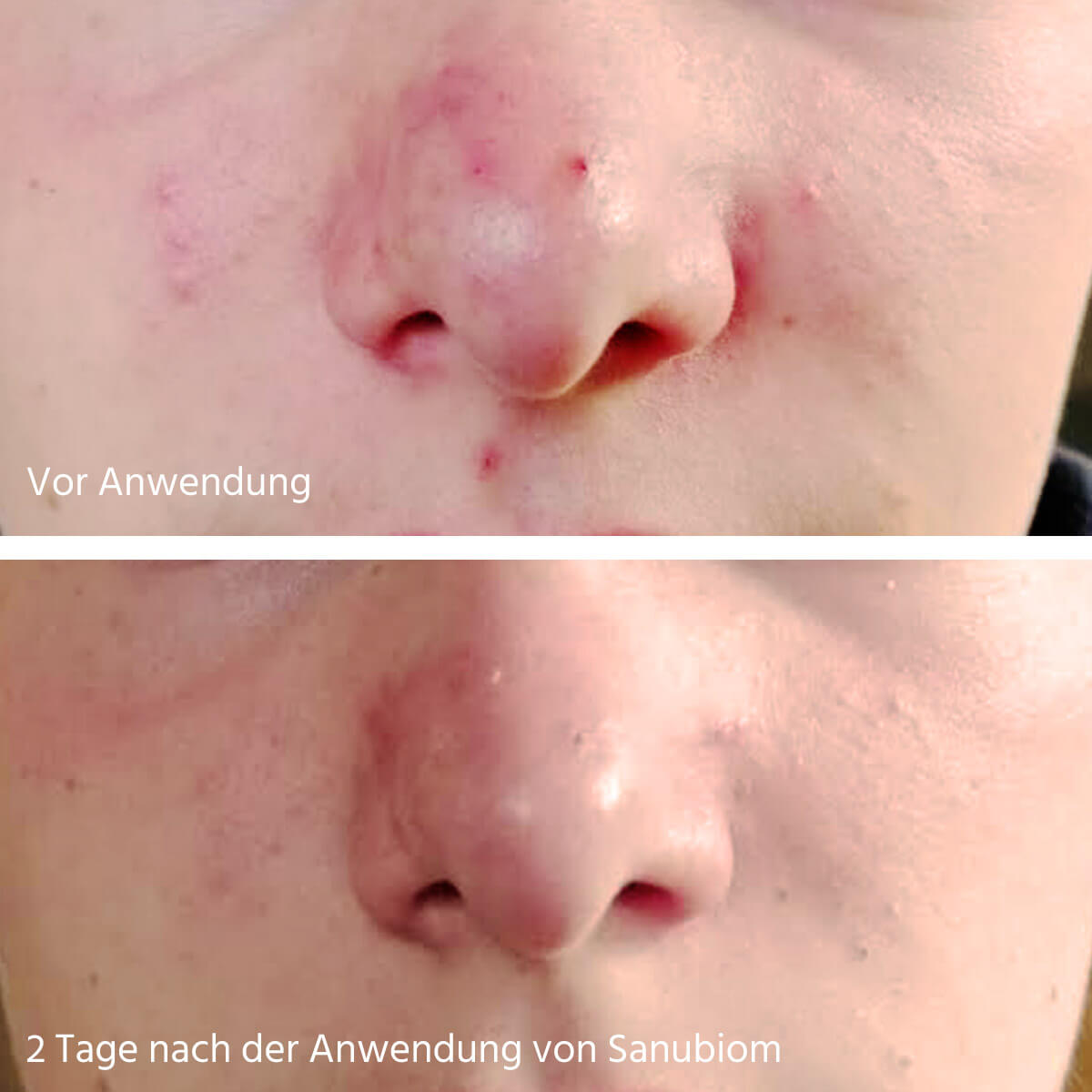 Sanubiom SkinCare Protect Anwendung bei Akne