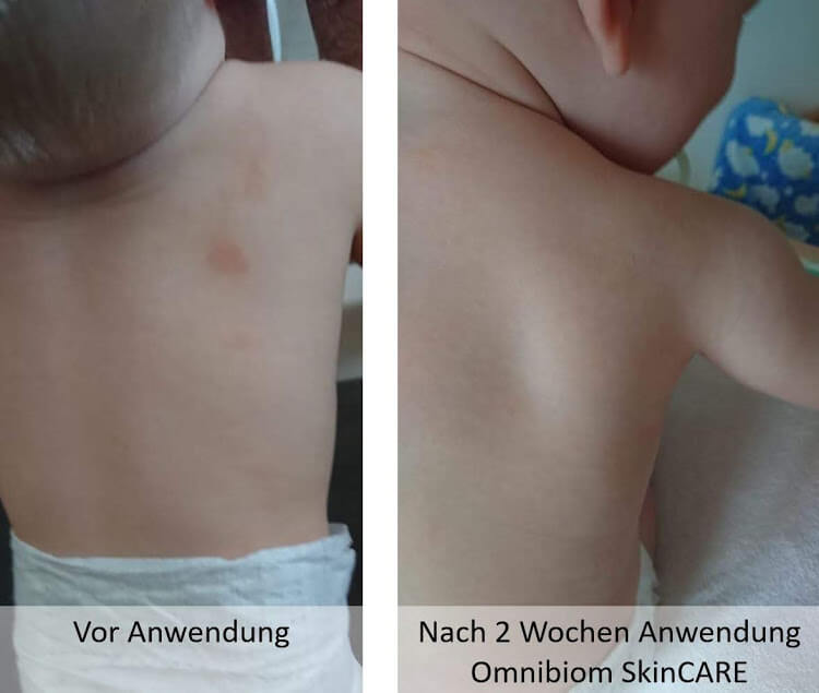 Anwendung von Sanubiom SkinCare: Neurodermitis bei Kleinkind