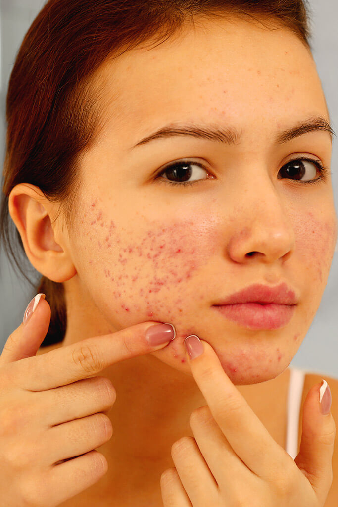 Acne treatment - medication and alternative therapy