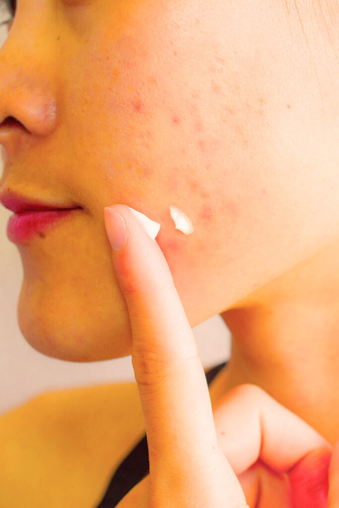 Fattori scatenanti dell'acne