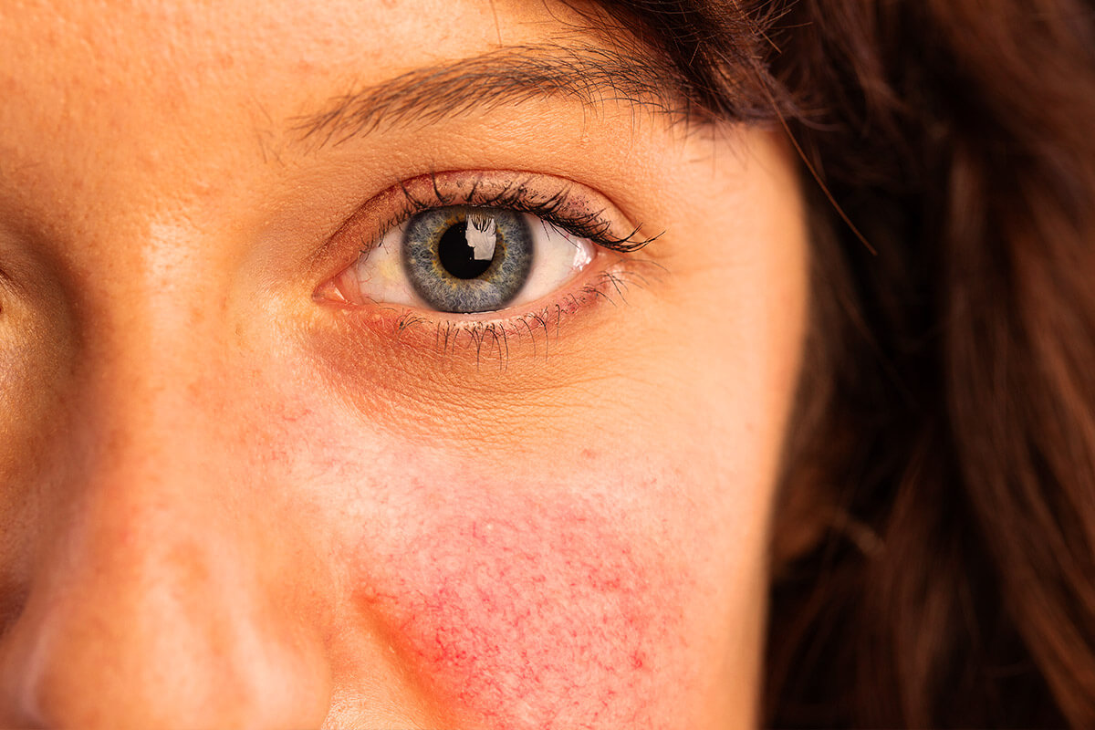 I batteriofagi riducono il rossore nella rosacea