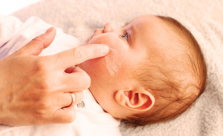 Neurodermitis bei Kindern – Behandlung mit Phagen