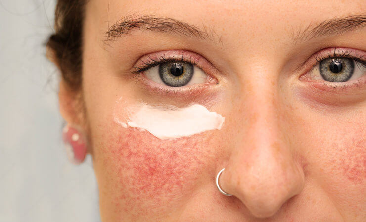 Rosacea Behandlungsmöglichkeiten