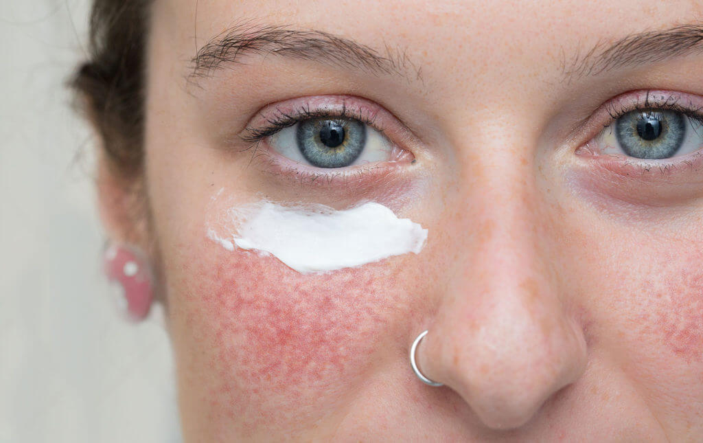 Rosacea mittels Creme behandlen