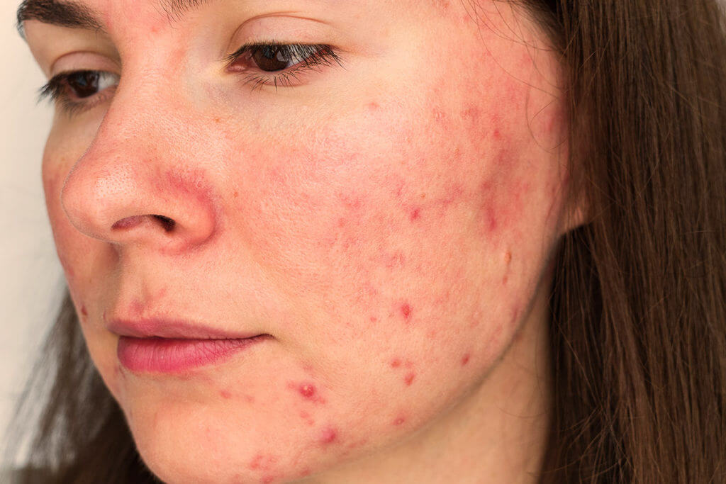 Who is affected by rosacea?