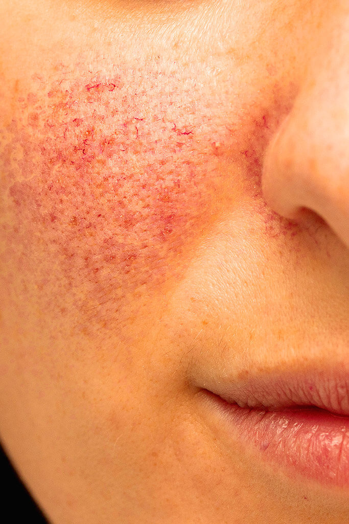 Wie kann Rosacea (Rosazea) behandelt werden?