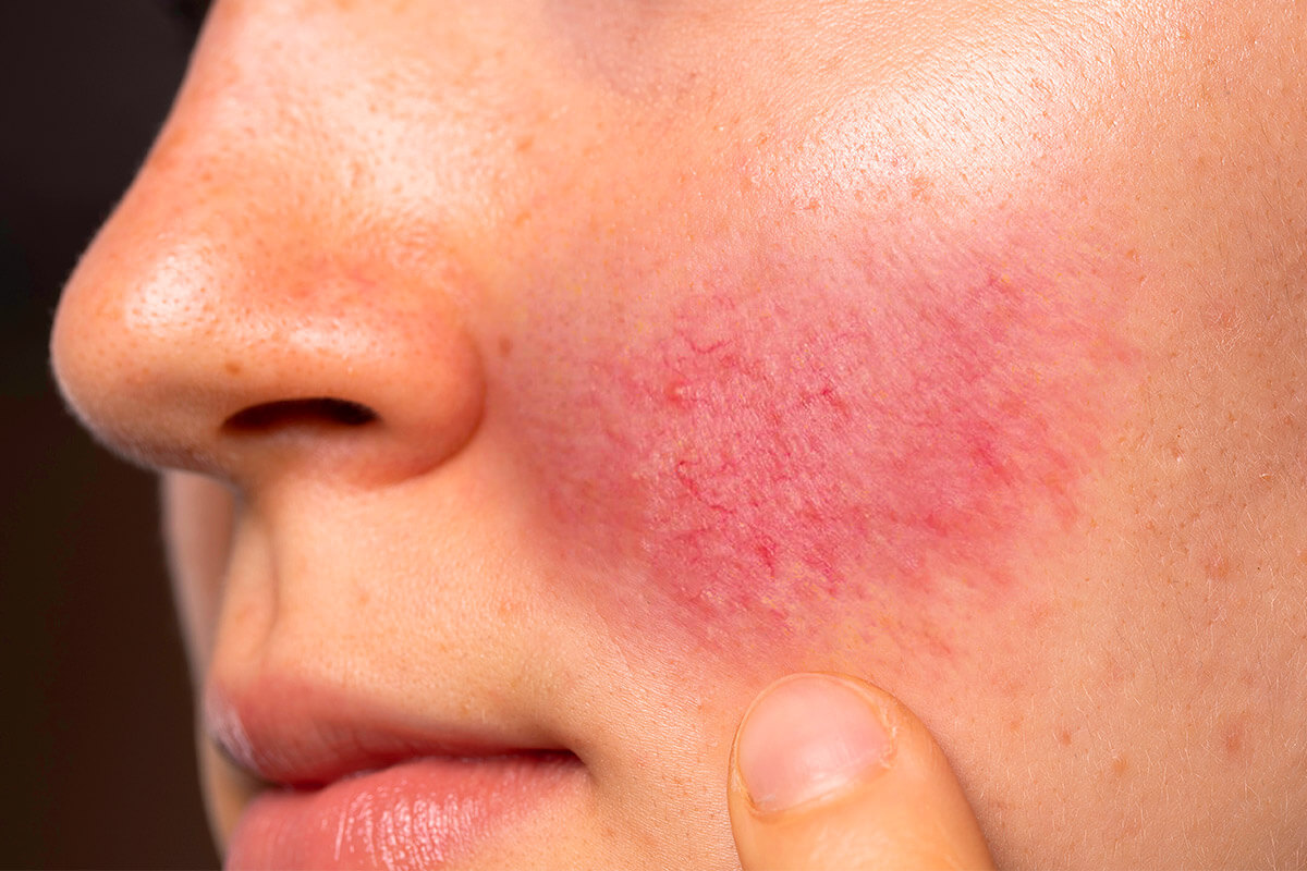 Rosacea Ursachen, Symptome & Behandlung! Sanubiom