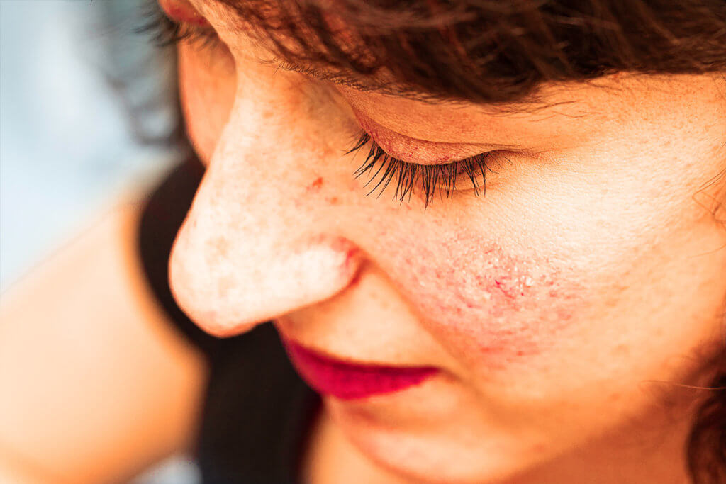Rosacea: riequilibrare la pelle con i batteri che mangiano