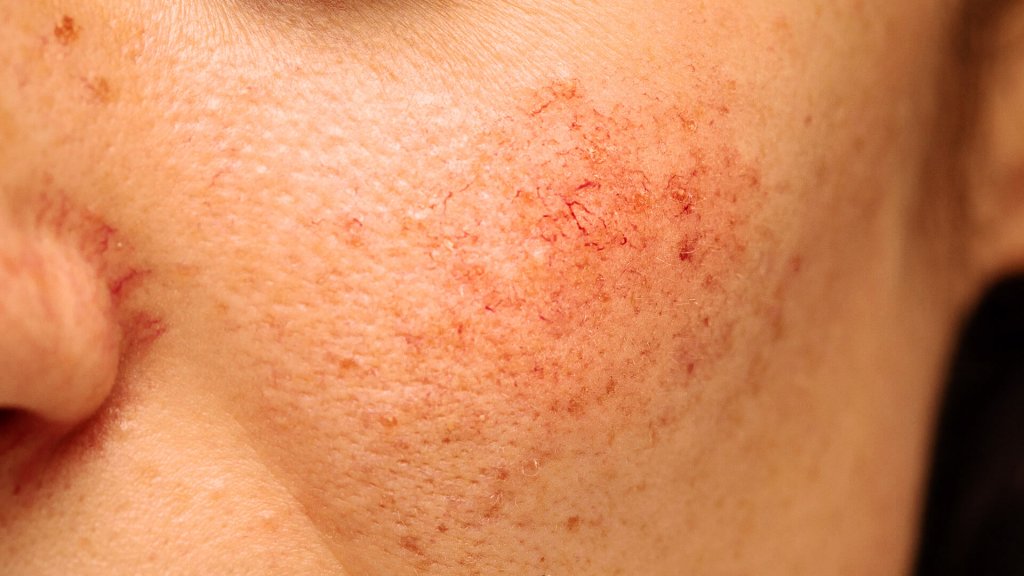 Wie lange dauert ein Rosacea Schub an?