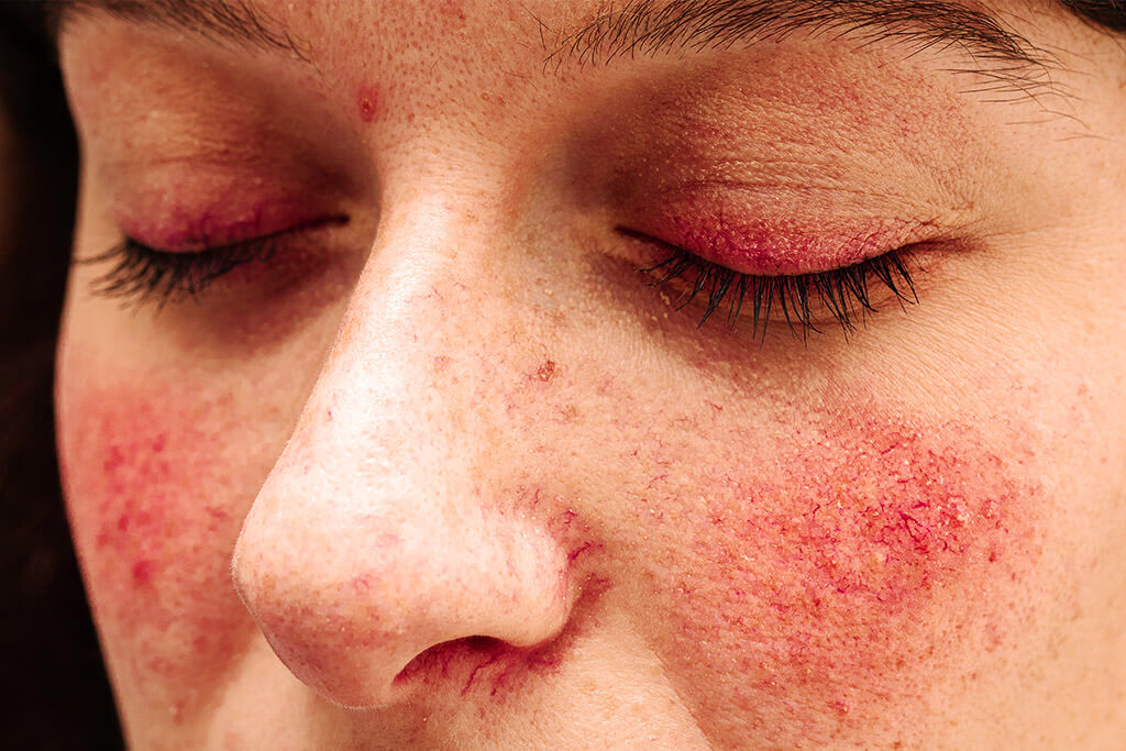 About skin flora, skin irritation and skin redness