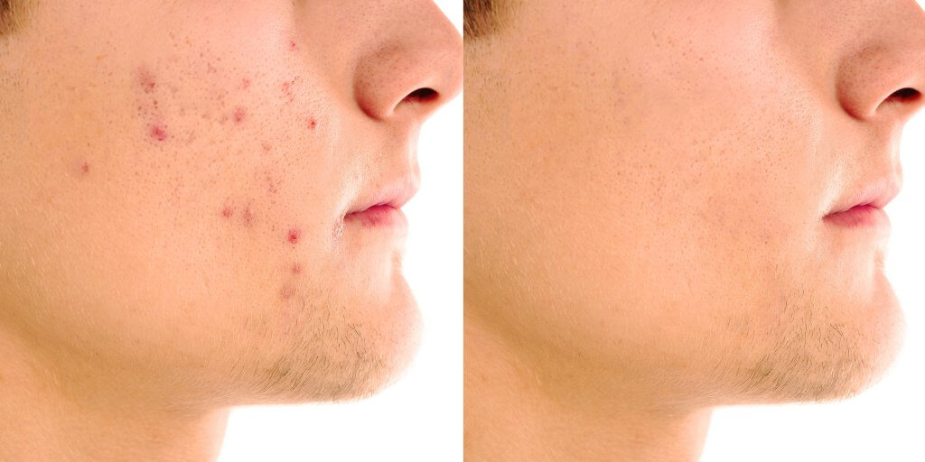 Confronto tra il prima e il dopo dell'acne