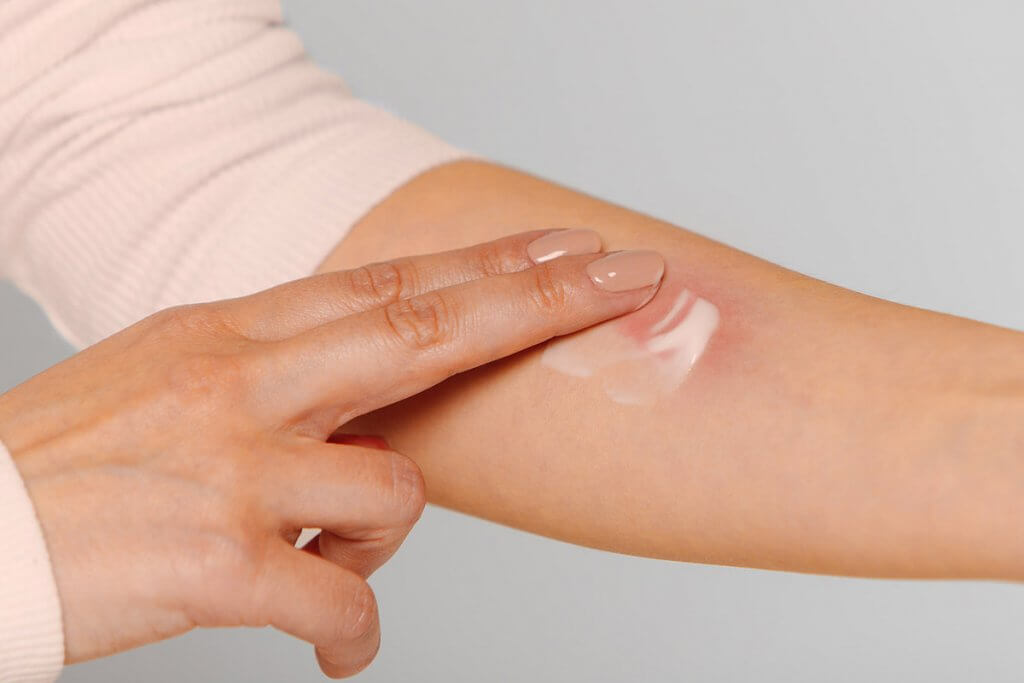 Applicazione locale attraverso la pelle con una pomata al cortisone