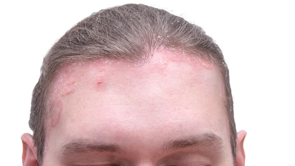 neurodermatitis-on-the-scalp