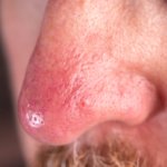 Rosacea auf der Nase