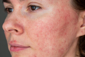 frau mit rosacea im gesicht