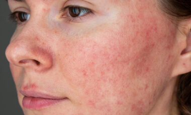 frau mit rosacea im gesicht